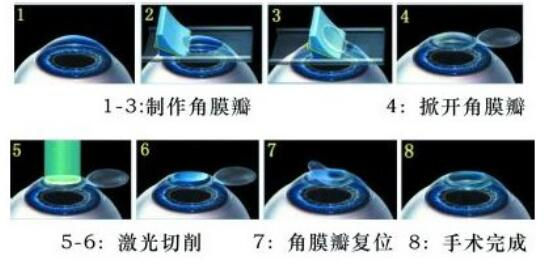 準分子激光手術到底是怎么治 愈你的眼睛的？