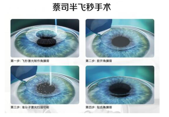 準分子激光手術到底是怎么治 愈你的眼睛的？