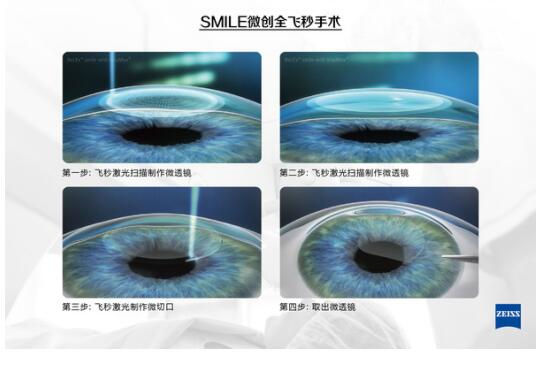 準分子激光手術到底是怎么治 愈你的眼睛的？