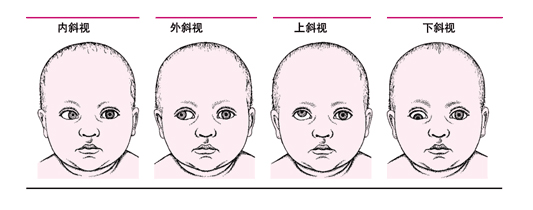 什么是斜視？斜視能嗎？
