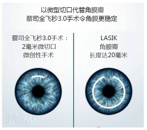 做完近視手術(shù)要休息多長時間？需要住院嗎？