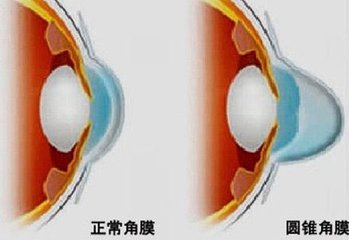 圓錐角膜，哪種角膜移植術(shù)好？
