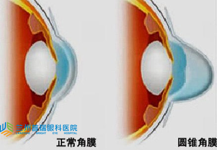 圓錐角膜怎樣？