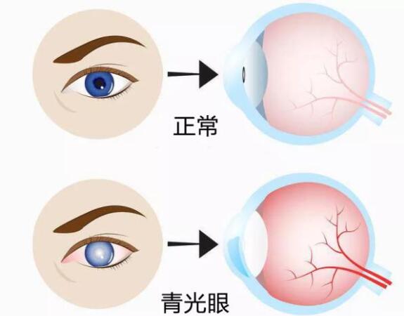第17個青光眼周｜共管慢病青光眼，留得光明恒久遠
